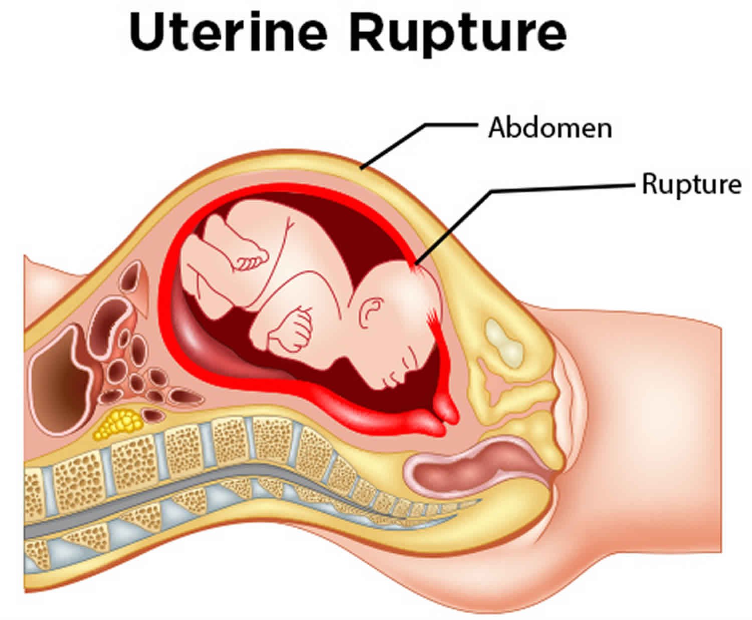 Rupture Uterus | Chapter 17 | Midwifery For Diploma In Nursing